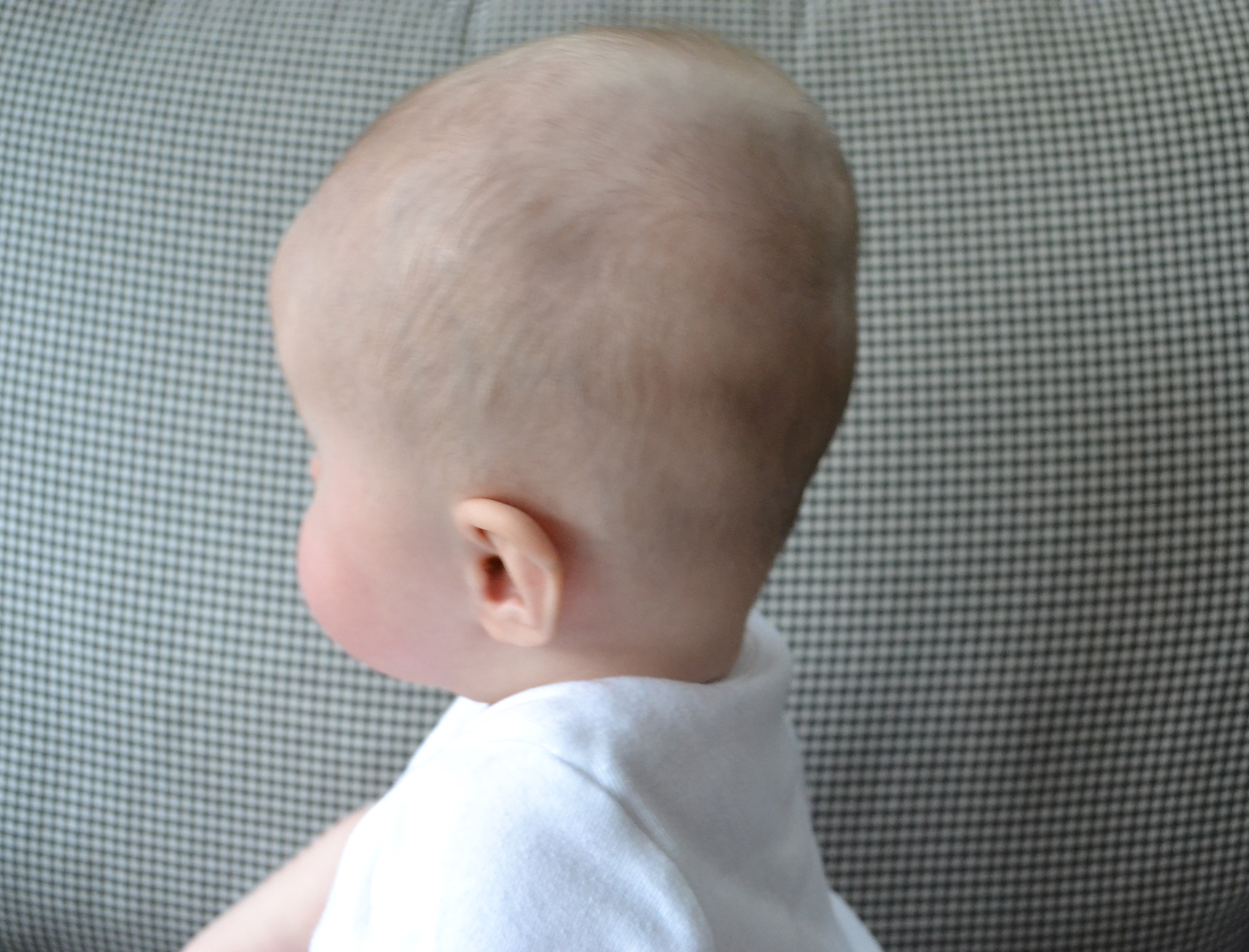 Маленький затылок. Лобная кефалогематома. Краниостеноз брахицефалия. Форма головы новорожденного.